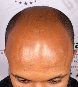 male pattern baldness fix with SMP
