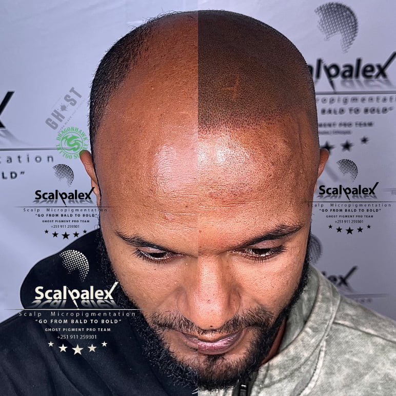 before and after scalp micropigmentation