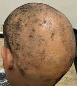 Alopecia Areata fix with hair tattoo