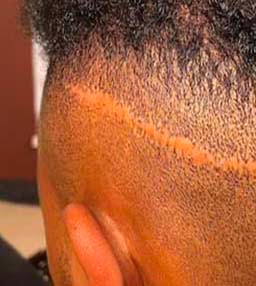 hair transplant FUT scar fix with scalp micropigmentation