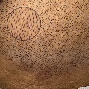 scalpalex exclusive hair strokes first session