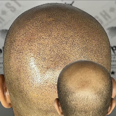 exclusive spiral crown technique