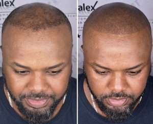 Hair Transplant vs Scalp Micropigmentation