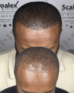 Scalp Micropigmentation as a PRP Treatment