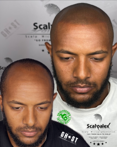Can i donate blood after Scalp Micropigmentation ?